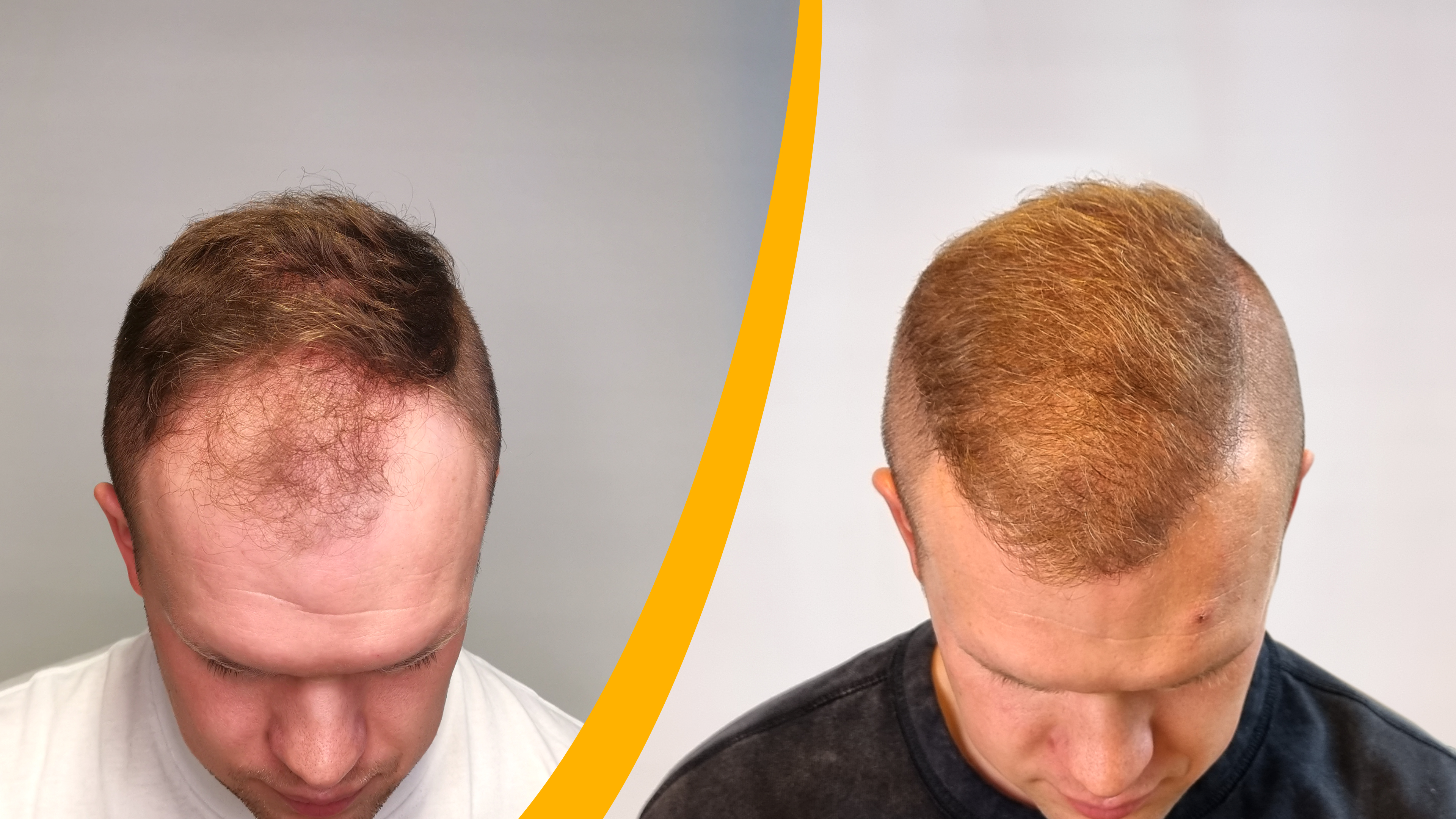Avant-Après - Résultat de la greffe de cheveux Avant-Après - Résultat de la greffe de cheveux