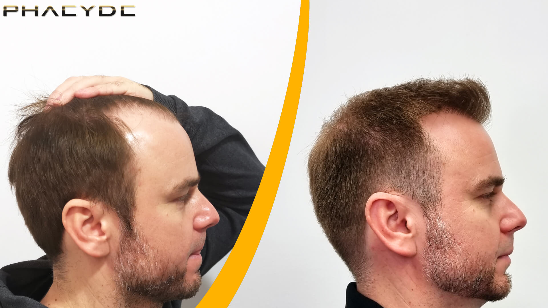 Avant et après une greffe de cheveux Avant et après une greffe de cheveux