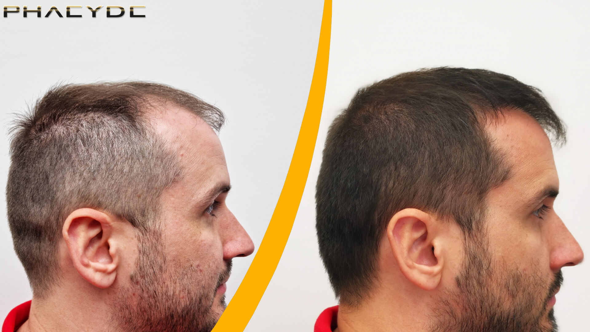 Avant et après une greffe de cheveux Avant et après une greffe de cheveux
