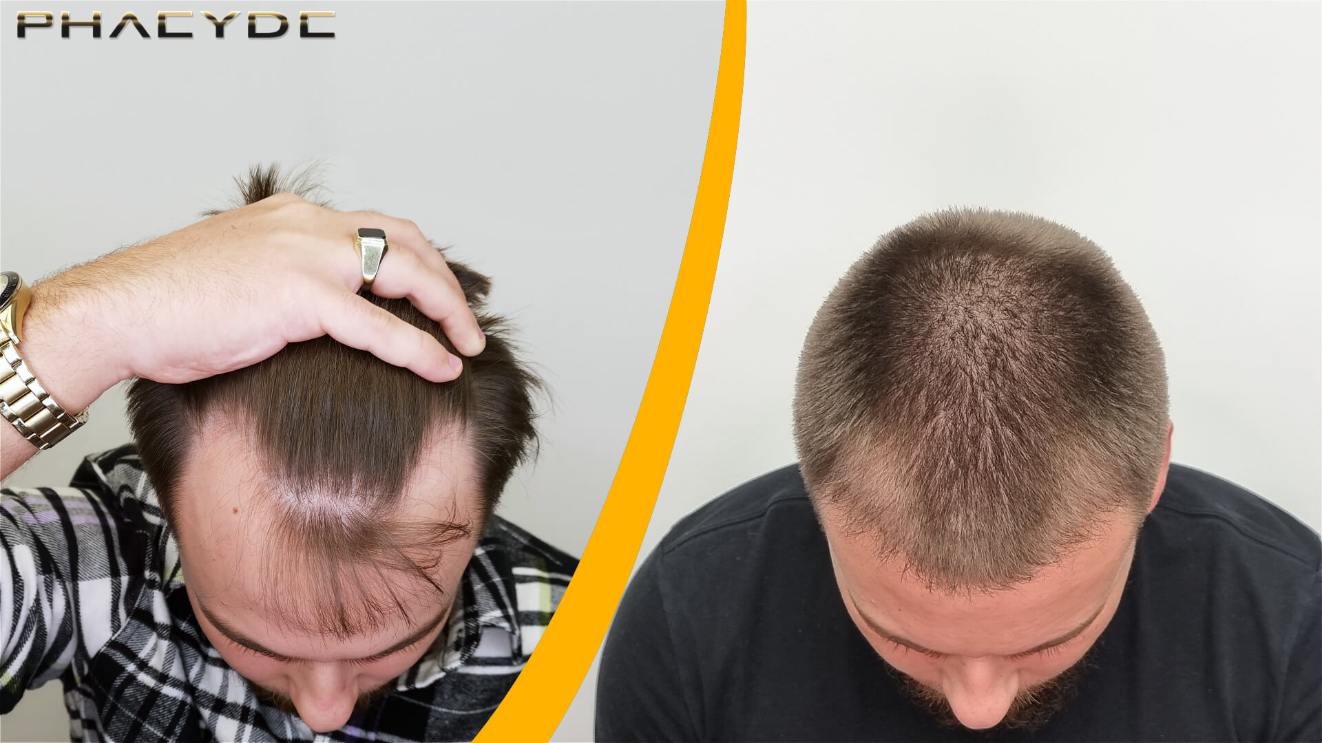 Résultat avant et après la greffe de cheveux Résultat avant et après la greffe de cheveux