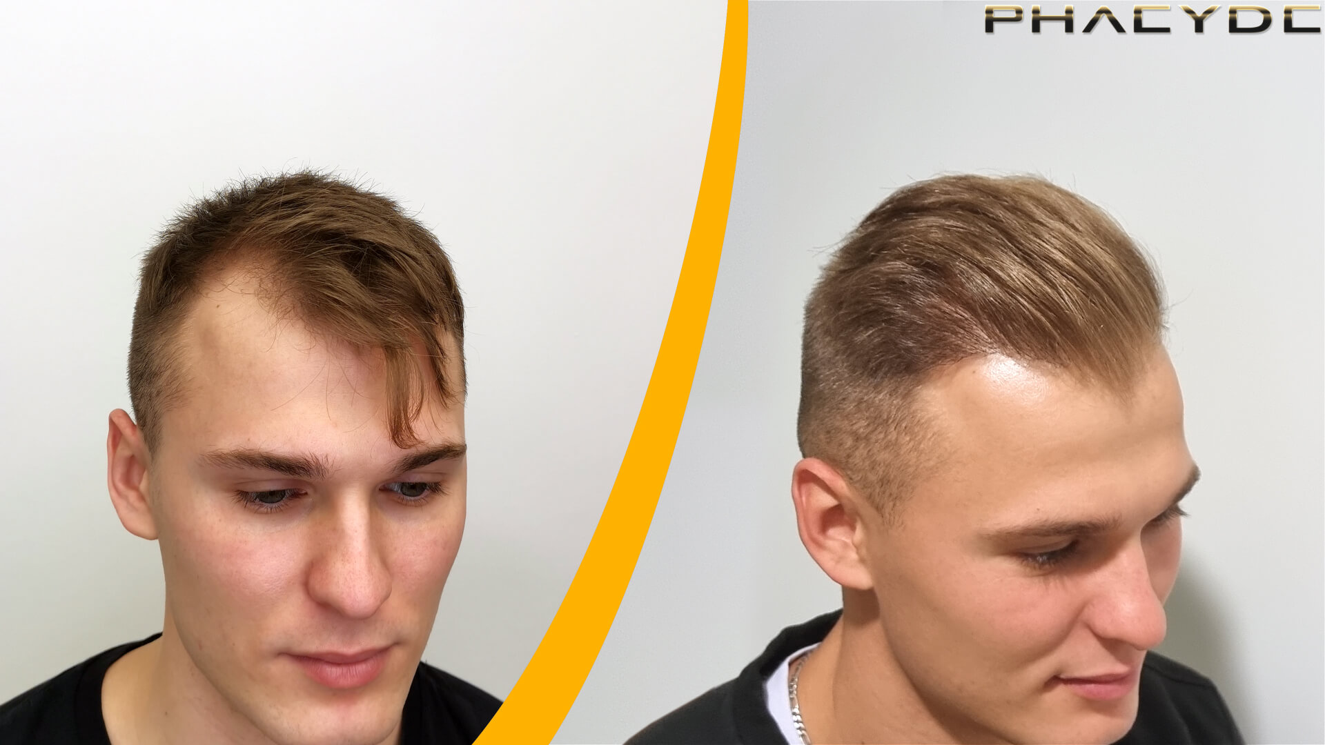 Résultats Avant et Après la Greffe de Cheveux Résultats Avant et Après la Greffe de Cheveux