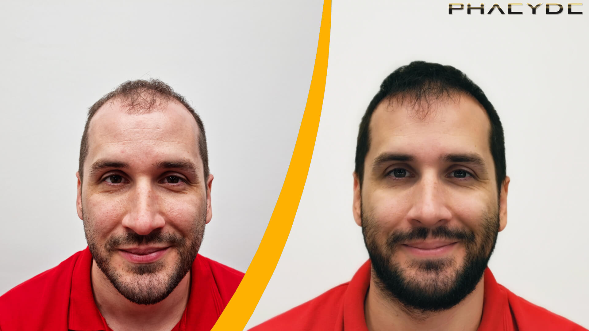 Résultats Avant et Après la Greffe de Cheveux Résultats Avant et Après la Greffe de Cheveux
