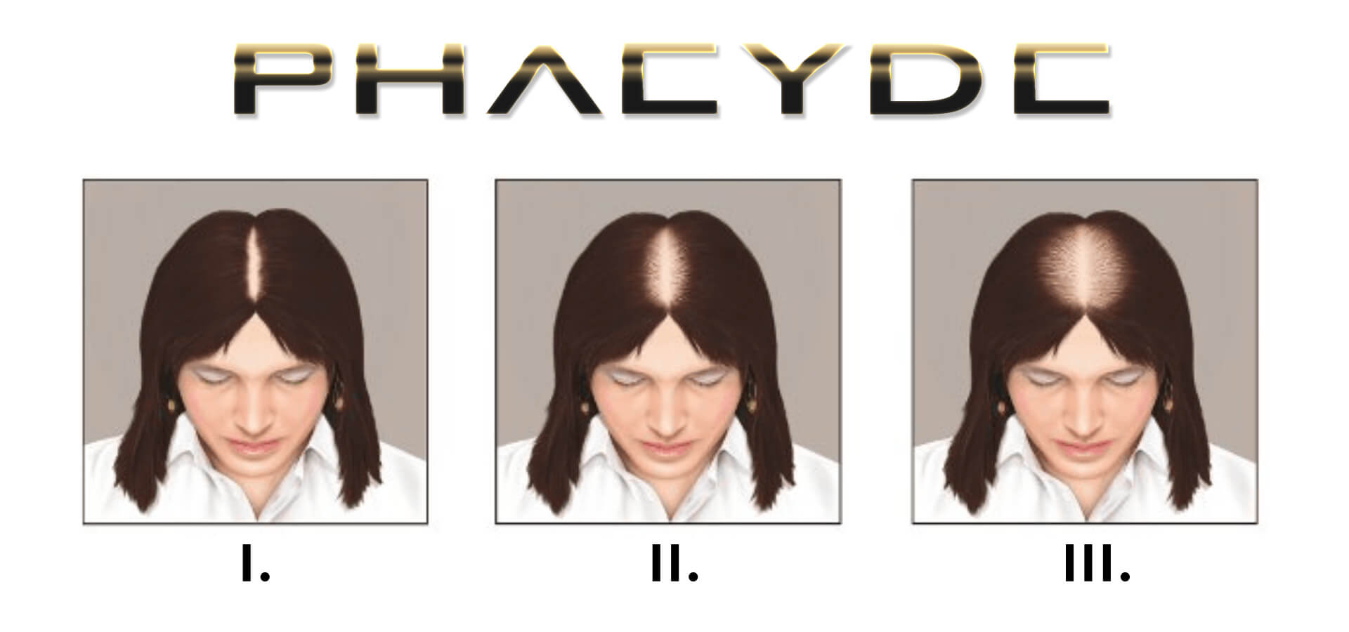 Échelle de Ludwig: Stades de la perte de cheveux chez les femmes Échelle de Ludwig: Stades de la perte de cheveux chez les femmes