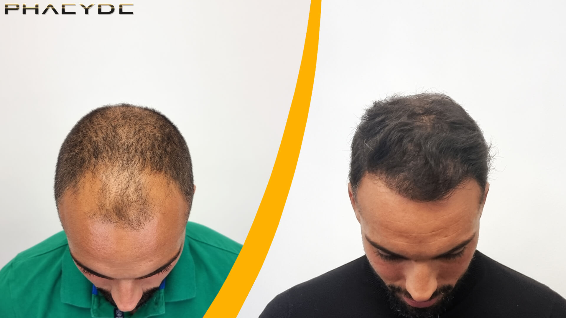Résultat de la Greffe de Cheveux Avant-Après Résultat de la Greffe de Cheveux Avant-Après
