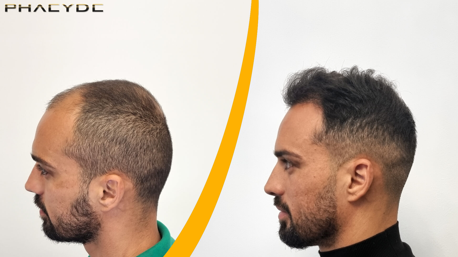 Greffe de cheveux - Résultat avant & après Greffe de cheveux - Résultat avant & après