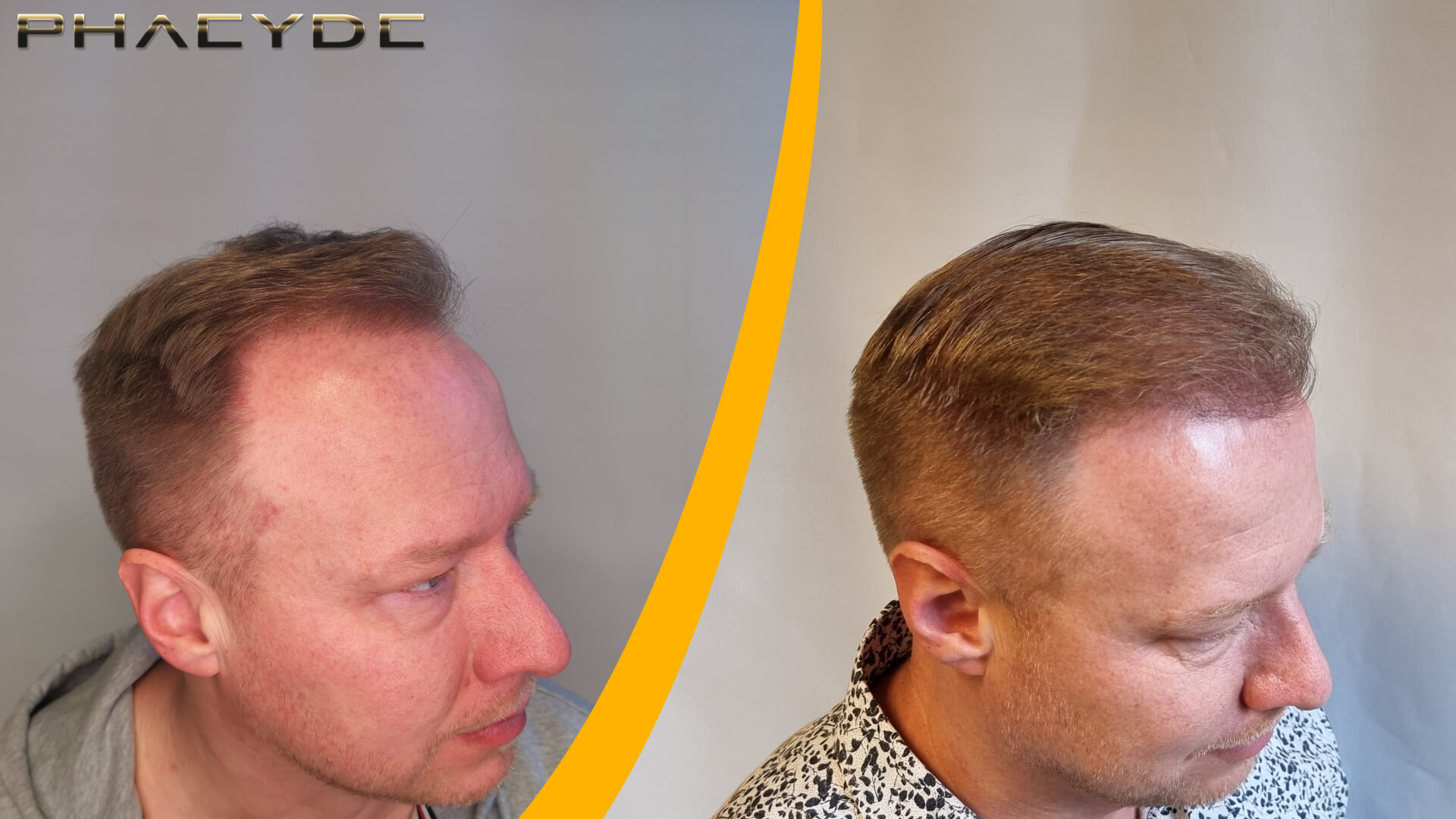 Avant & Après la Greffe de Cheveux – 1600 Greffons Avant & Après la Greffe de Cheveux – 1600 Greffons