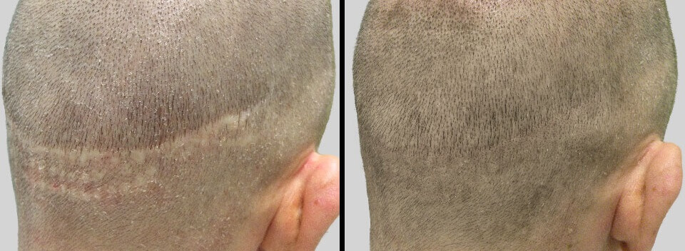 SMP (micropigmentation du cuir chevelu) avant et après SMP (micropigmentation du cuir chevelu) avant et après