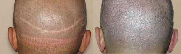 SMP (micropigmentation du cuir chevelu) avant et après SMP (micropigmentation du cuir chevelu) avant et après