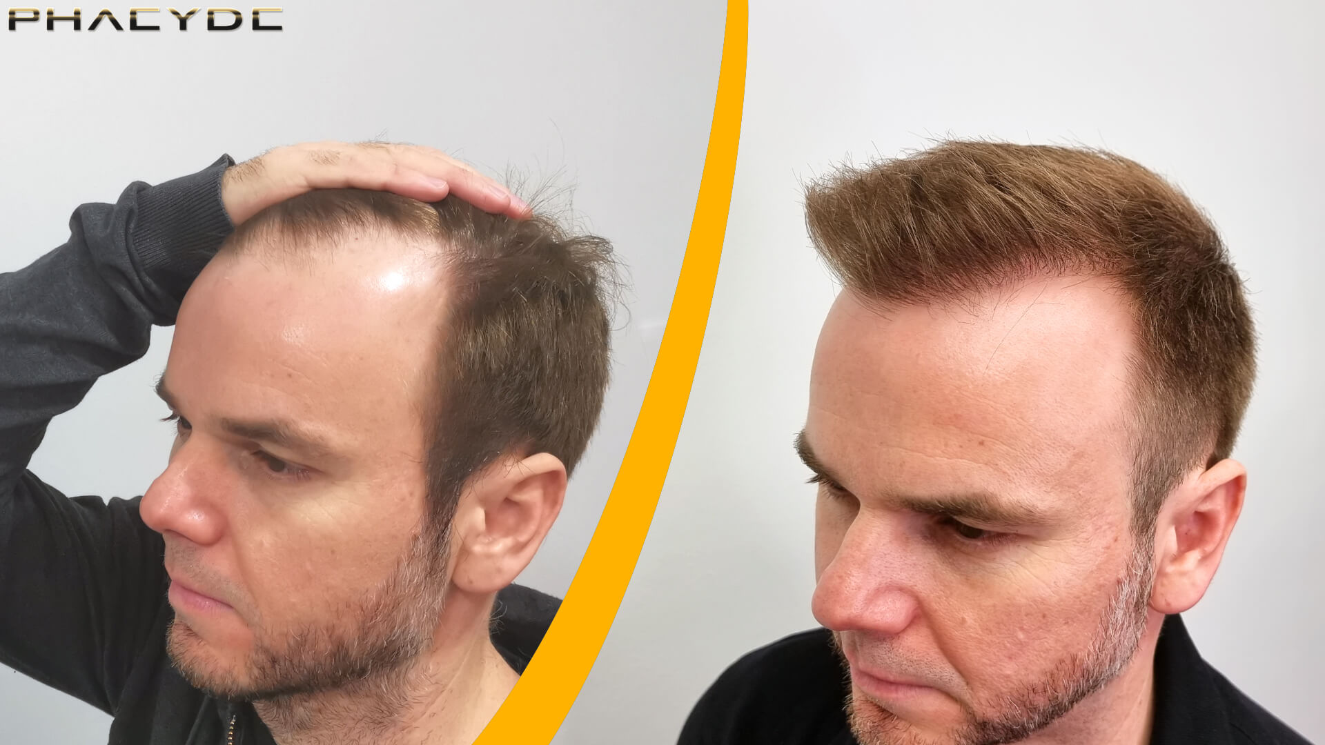 Greffe de cheveux - Résultat avant & après Greffe de cheveux - Résultat avant & après