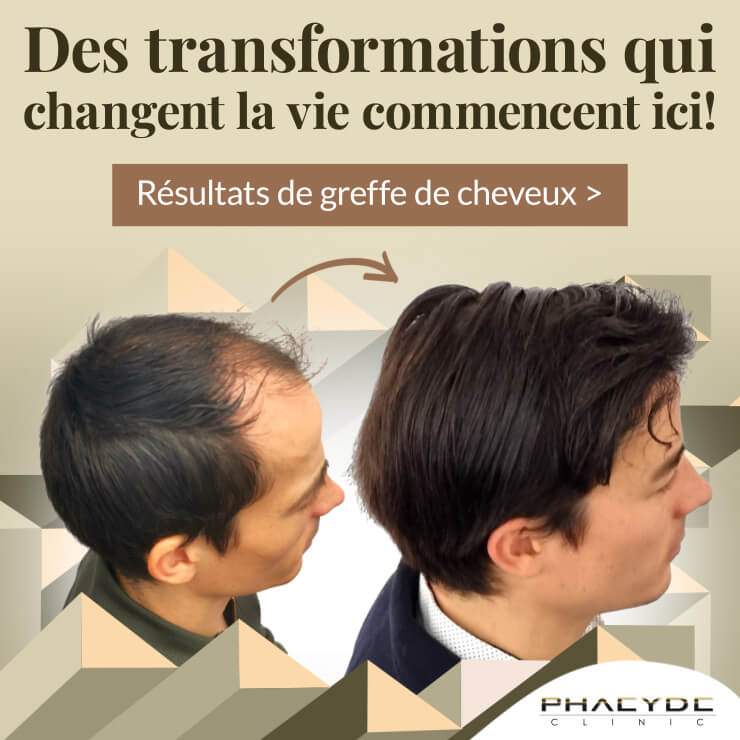 Greffe de cheveux Leader dans la transplantation de cheveux.