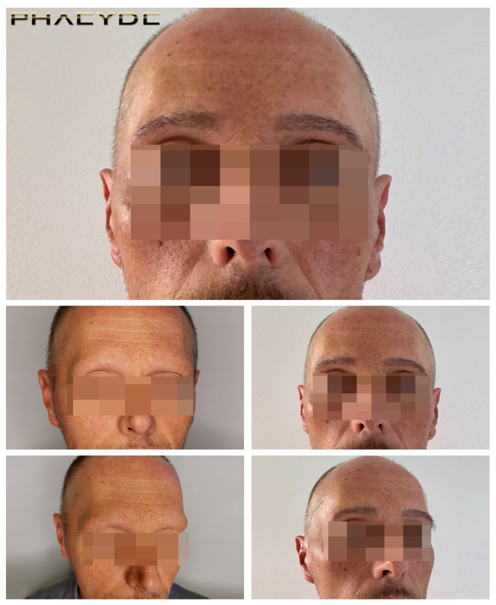 Transplantation de sourcils Transplantation de sourcils