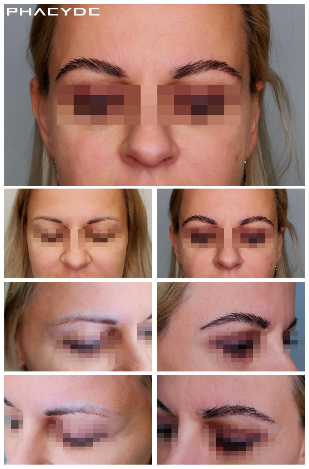 Transplantation de sourcils Transplantation de sourcils