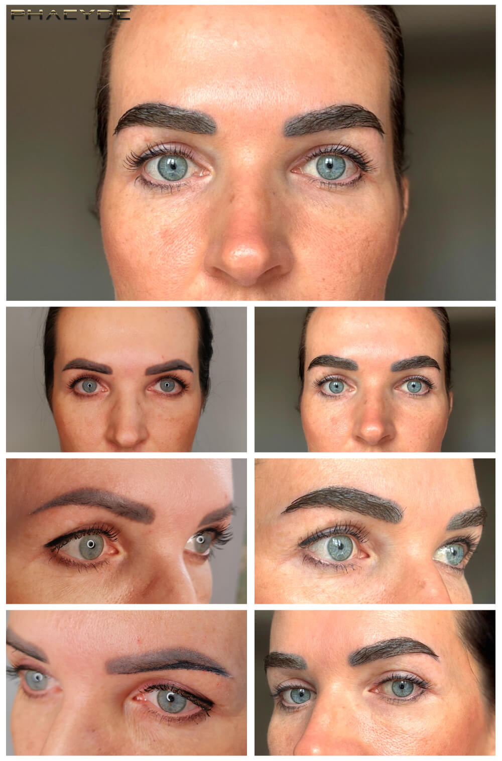 Transplantation de sourcils