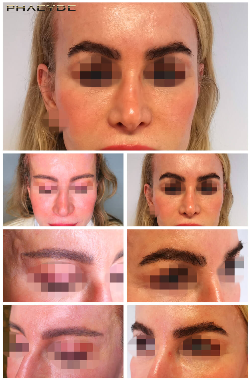 Transplantation de sourcils